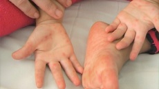 Phòng ngừa và cải thiện bệnh tay chân miệng hiệu quả bằng thảo dược