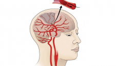 Tại sao nên dùng nattokinase để phòng ngừa và cải thiện đột quỵ não do cục máu đông?