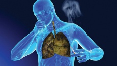 Sử dụng thảo dược để hỗ trợ ngăn ngừa ung thư phổi tái phát