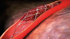 Ưu và nhược điểm của phương pháp đặt stent động mạch vành