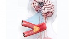 Mối liên hệ giữa nhồi máu não và xơ vữa động mạch