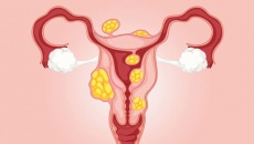 U xơ tử cung ảnh hưởng đến sức khỏe như thế nào?