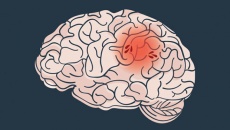 Những điều cần biết về đột quỵ não lần hai và cách phòng ngừa