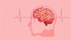 Ai dễ bị tai biến mạch máu não?
