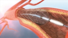 Đặt stent động mạch cảnh có ưu điểm và nhược điểm như thế nào?