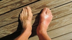 Dấu hiệu bệnh gout ở chân và cách kiểm soát bệnh từ thảo dược
