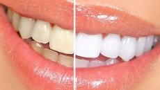 “Điểm mặt” 6 thói quen khiến răng bạn ố vàng