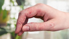 Cách chăm sóc da khi mắc bệnh chàm ở bàn tay