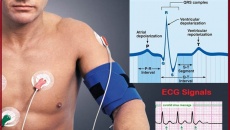Vai trò của đo điện tâm đồ liên tục trong kiểm soát rối loạn nhịp tim?