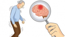 Đột quỵ nhồi máu não: Hiểu về bệnh để điều trị đúng cách