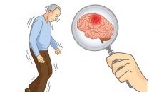 5 giai đoạn bệnh Parkinson và lưu ý điều trị cho từng giai đoạn