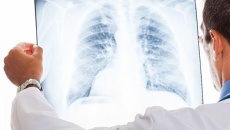 Người đã mắc COVID-19 có nên đi chụp phổi?
