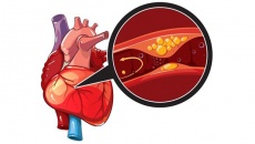 Thiếu máu cơ tim là gì, bệnh có những dạng nào?