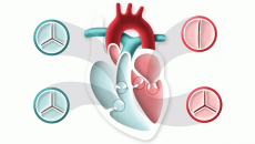 Đâu là van tim hay bị hẹp, hở và dạng nào nguy hiểm nhất?