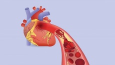 Làm sao dự phòng nhồi máu cơ tim ở người bệnh thiếu máu cơ tim?