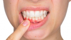 Cách đơn giản để phòng ngừa chảy máu chân răng