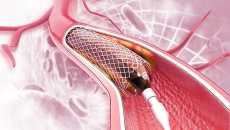 Những ai không được đặt stent để điều trị bệnh mạch vành?