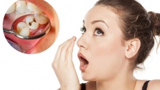 Sâu răng là “thủ phạm” gây hôi miệng?