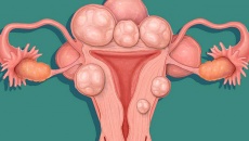U xơ tử cung: Biến chứng và cách cải thiện bệnh hiệu quả
