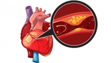 Thiếu máu cơ tim, ngoại tâm thu kèm đái tháo đường điều trị ra sao?