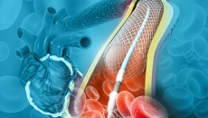 Bị tăng huyết áp, đái tháo đường đặt stent có khỏi hẳn bệnh mạch vành không?
