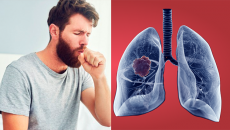 Một số dấu hiệu nhận biết ung thư phổi giai đoạn đầu 