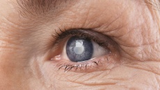 Bệnh võng mạc đái tháo đường: Biến chứng mắt nguy hiểm không nên coi thường