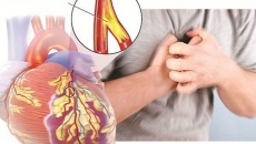 Xơ vữa động mạch: Nguyên nhân, điều trị và cách phòng tránh