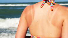 Mùa hè, cảnh giác với nguy cơ da bị ngộ độc nắng
