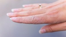 Mách bạn 5 cách chăm sóc da tay bị khô tại nhà