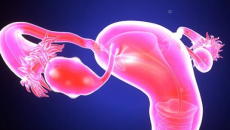 Dấu hiệu u nang buồng trứng và cách kiểm soát