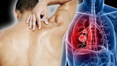 “Điểm mặt” những dấu hiệu cảnh báo bạn có thể mắc Ung thư phổi