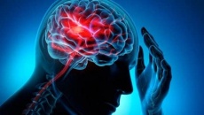 Những di chứng đáng chú ý của người bị tai biến mạch máu não