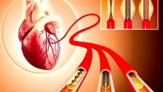 8 biến chứng sau khi đặt stent: Hiểu rõ để phòng ngừa rủi ro!