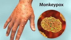 Việt Nam xuất hiện ca bệnh đậu mùa khỉ đầu tiên, Bộ Y tế chỉ đạo khẩn