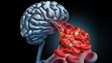 Xơ vữa động mạch ở người thiểu năng tuần hoàn não