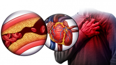 Nguy cơ xơ vữa động mạch ở người bệnh tim mạch
