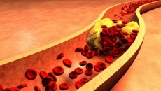 Mỡ máu cao và biến chứng nguy hiểm khi bị xơ vữa động mạch