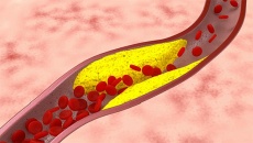 Xơ vữa động mạch ở người mỡ máu cao nguy hiểm thế nào?
