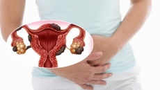 Mắc bệnh lạc nội mạc tử cung có bị vô sinh hiếm muộn không?