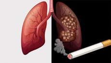 4 lầm tưởng về ung thư phổi bạn cần biết