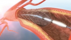 Ưu điểm và những lưu ý khi đặt stent động mạch vành