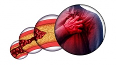 Người bệnh Tim mạch cần làm gì để hạn chế nguy cơ xơ vữa động mạch?