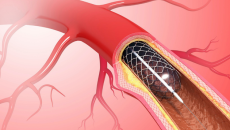 Đặt stent động mạch vành cần lưu ý những gì?