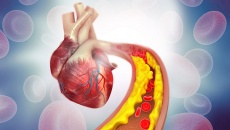 Những điều cần biết về xơ vữa động mạch vành