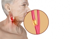 Đặt stent động mạch cảnh diễn ra thế nào?