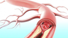 Người mắc bệnh Tim mạch phòng nguy cơ xơ vữa động mạch thế nào? 