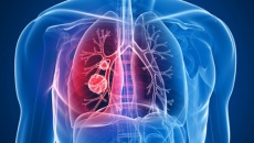 Dấu hiệu phát hiện sớm ung thư phổi di căn hạch trung thất