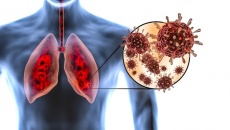 Tại sao có người bị di chứng phổi dai dẳng sau mắc COVID-19 nặng?