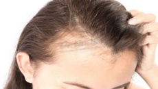 Một số phương pháp cải thiện tình trạng rụng tóc sau sinh